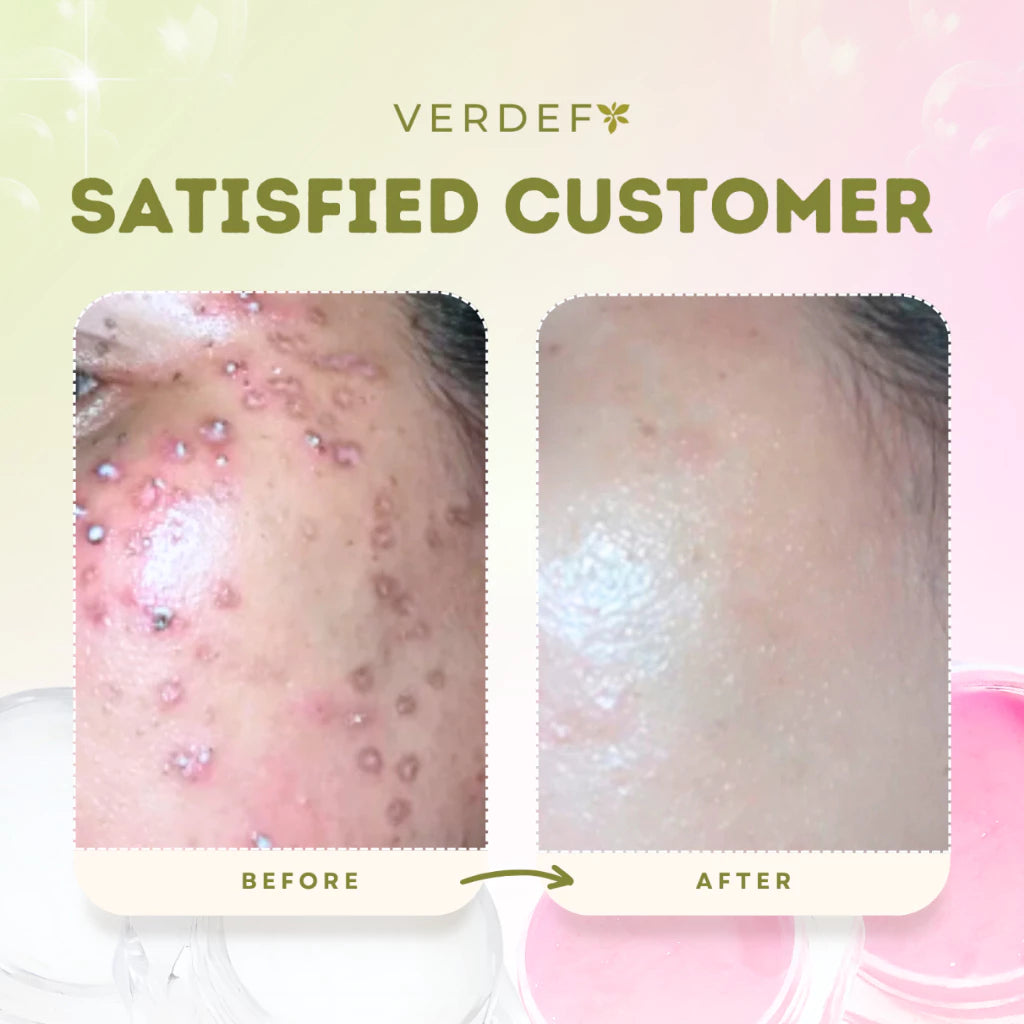 VERDEFY STRONG KASOY CREAM & SCAR CREAM SET
