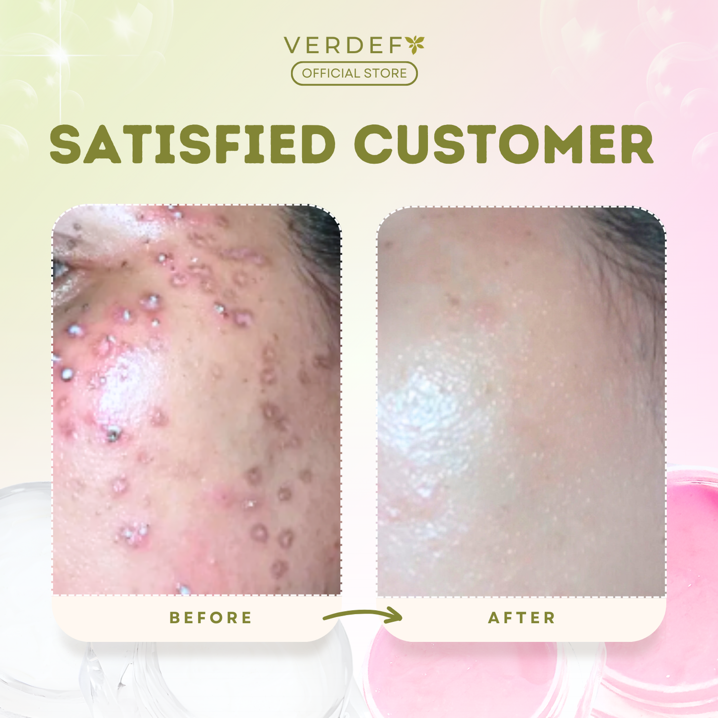 VERDEFY STRONG KASOY CREAM & SCAR CREAM SET