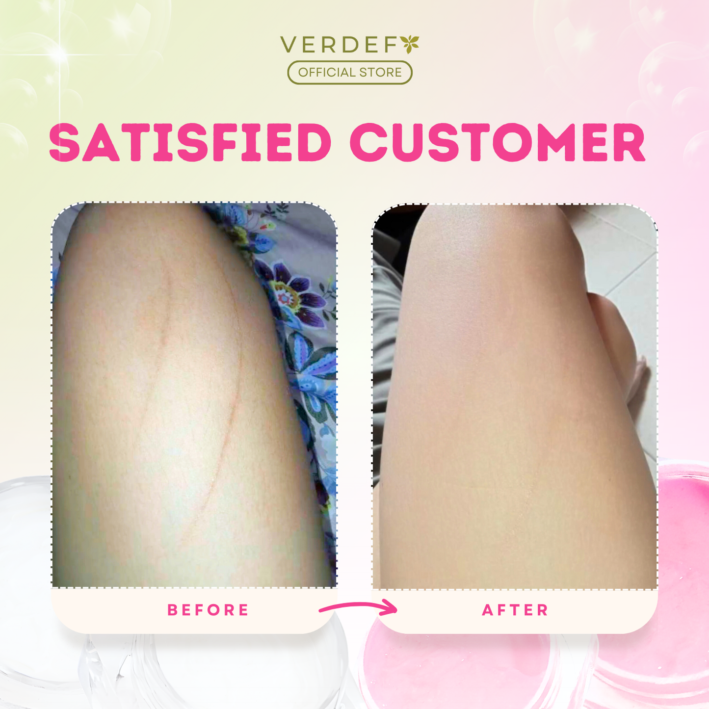 VERDEFY STRONG KASOY CREAM & SCAR CREAM SET