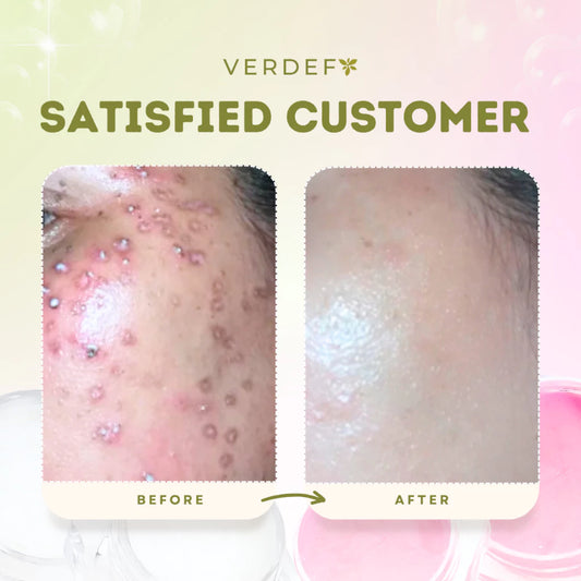 VERDEFY STRONG KASOY CREAM & SCAR CREAM SET