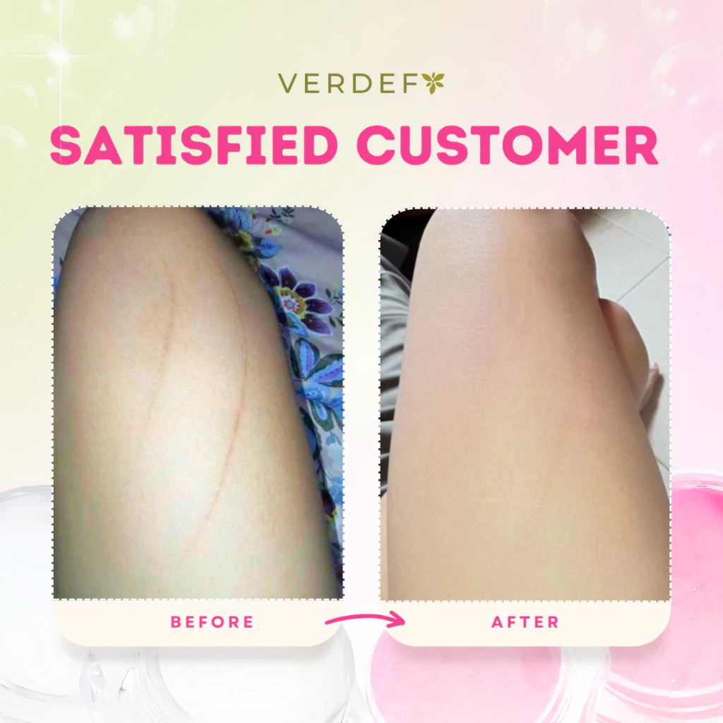 VERDEFY STRONG KASOY CREAM & SCAR CREAM SET